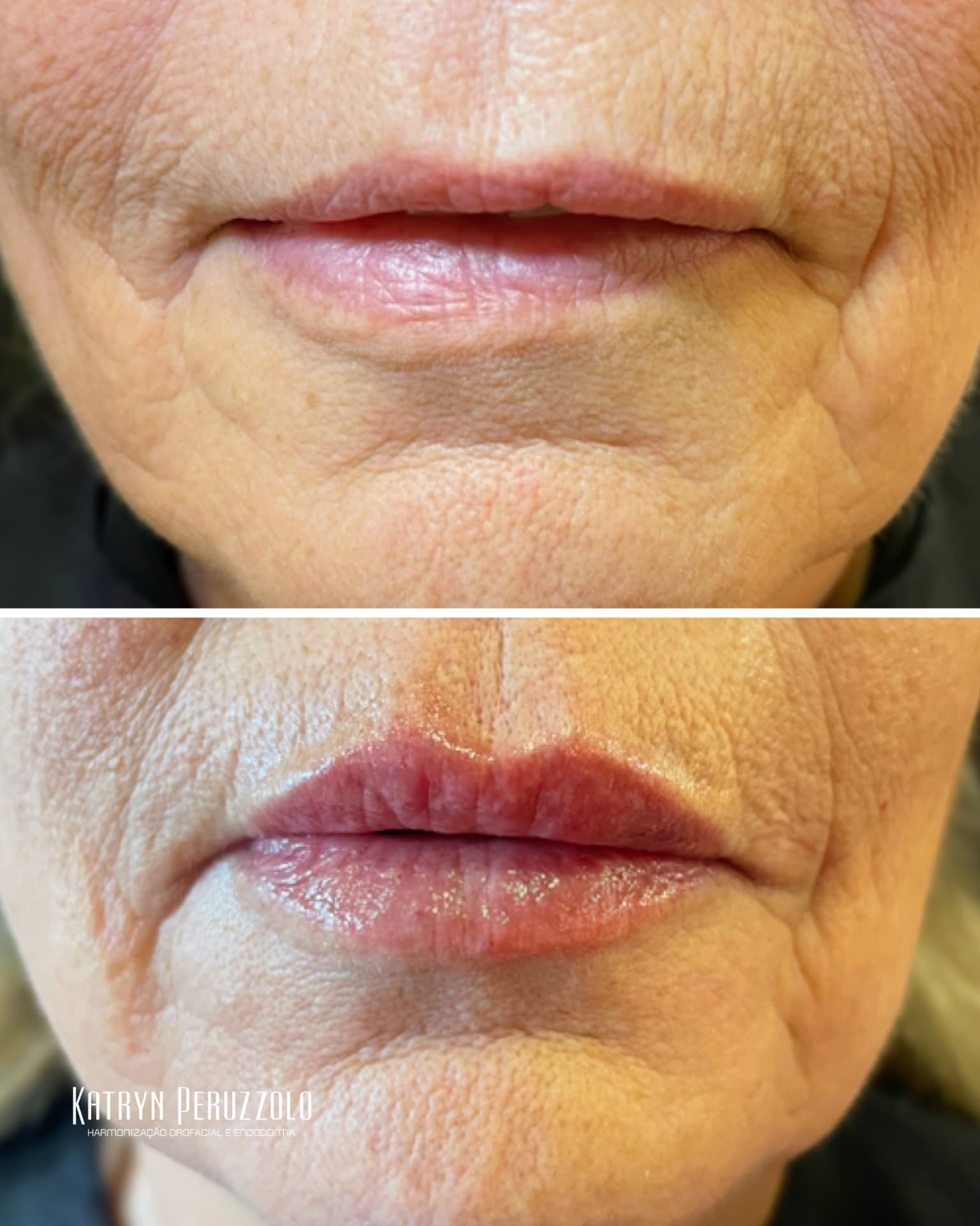 Antes e depois – Preenchimento labial