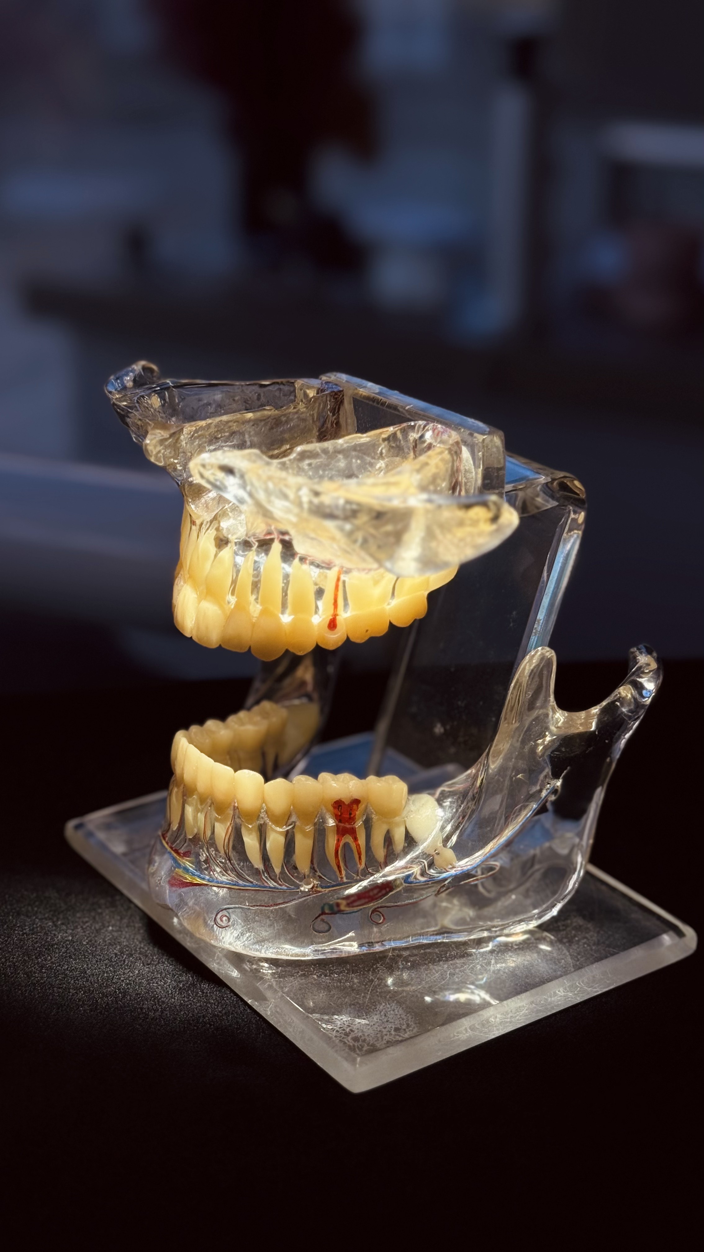 Ilustração clínica de implante dentário para reabilitação funcional e estética