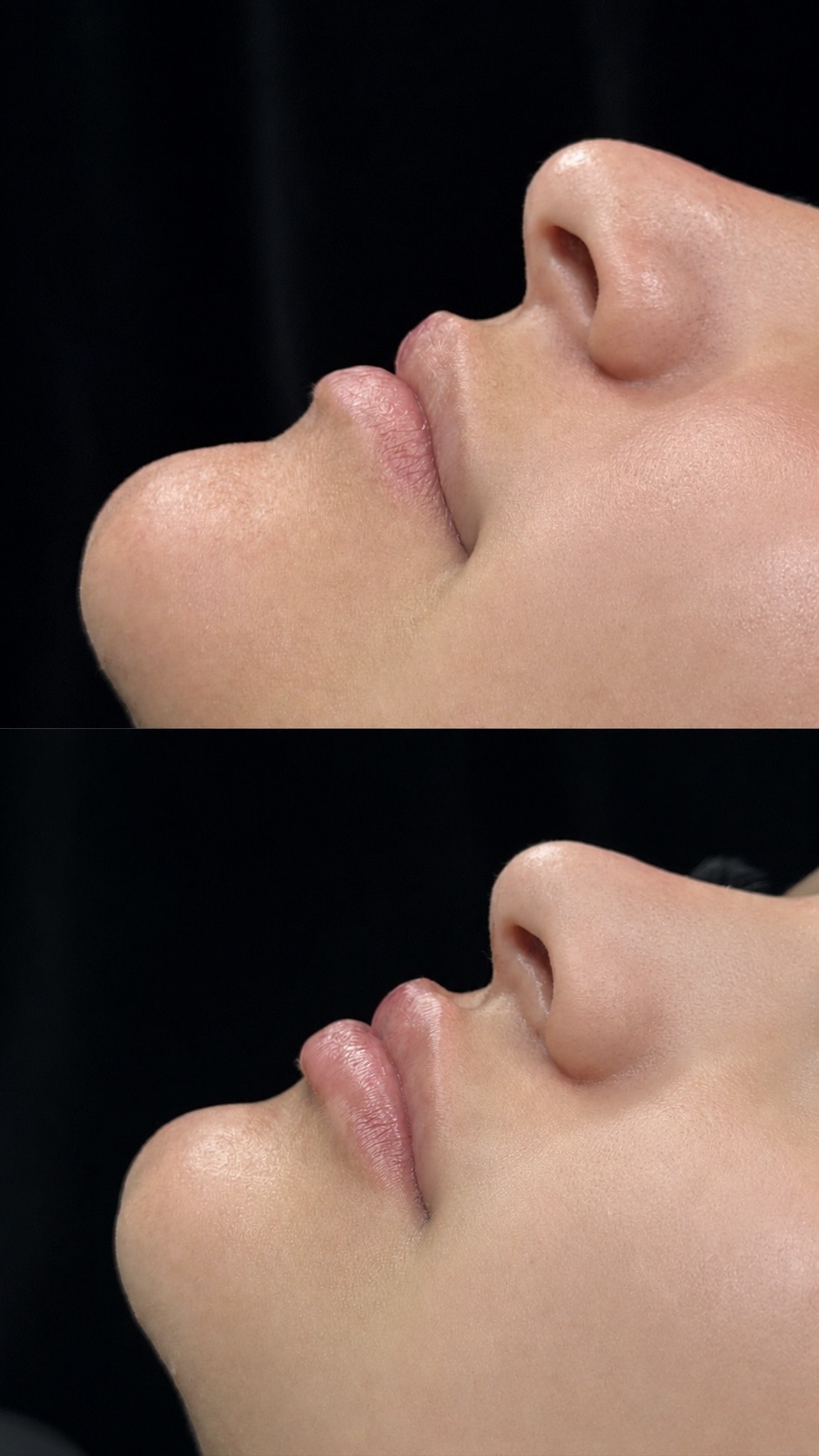 Antes e depois – Preenchimento labial