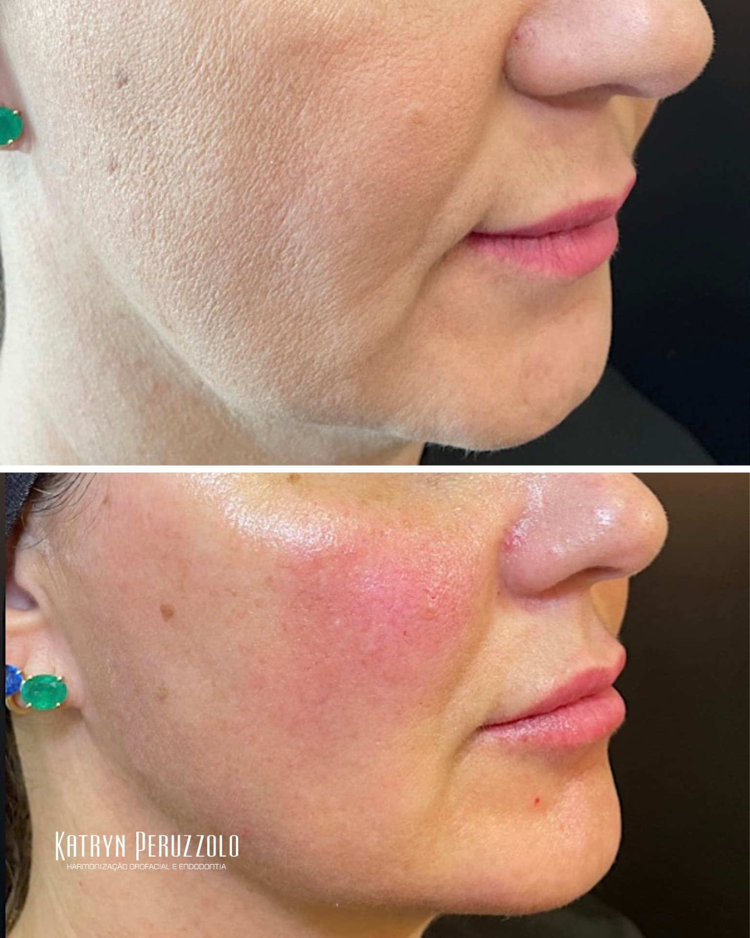 Antes e depois – Harmonização facial completa