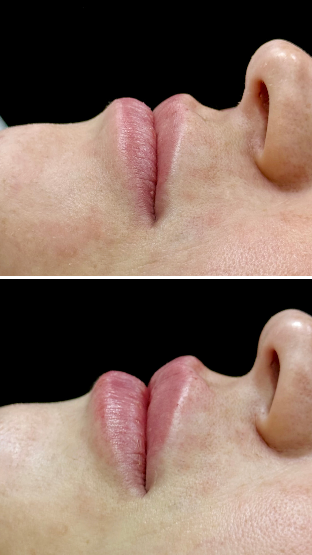 Antes e depois – Preenchimento labial