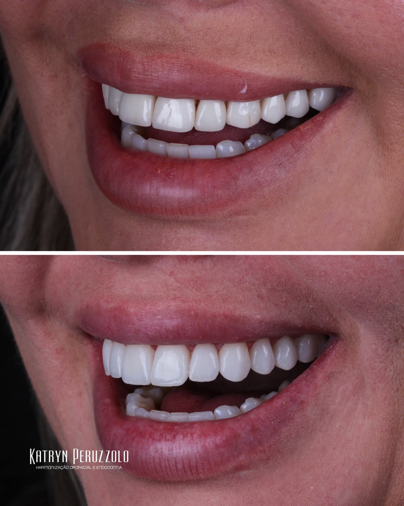 Antes e depois – Lentes de contato dental