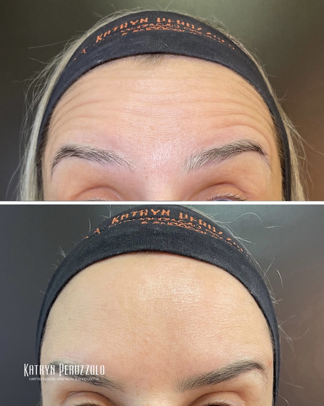 Antes e depois – Toxina botulínica (testa)