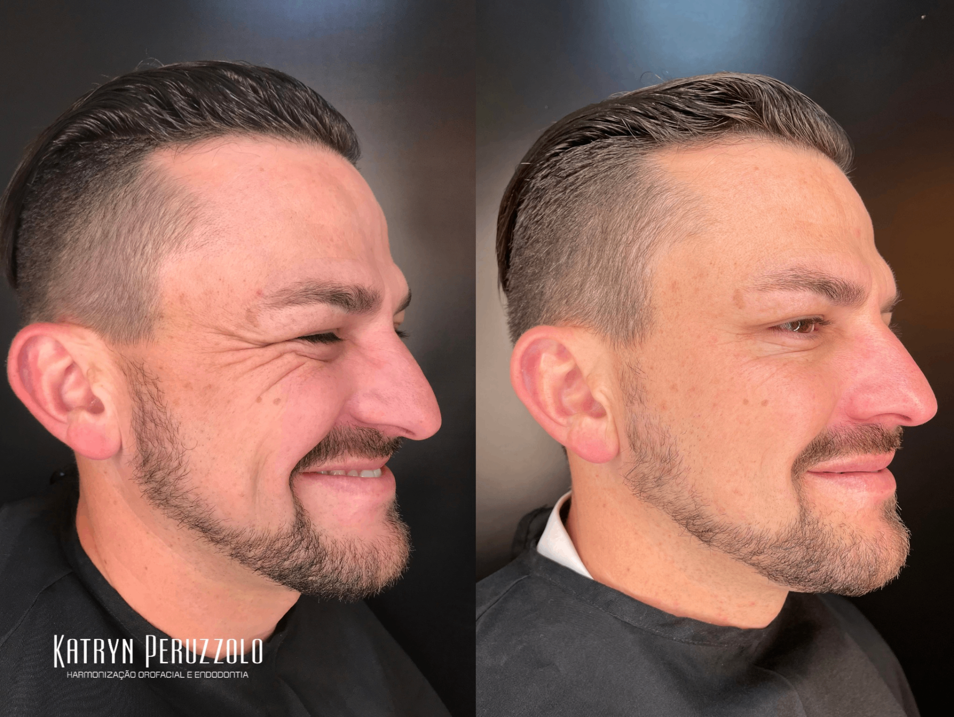 Antes e depois – Toxina botulínica (pés de galinha)