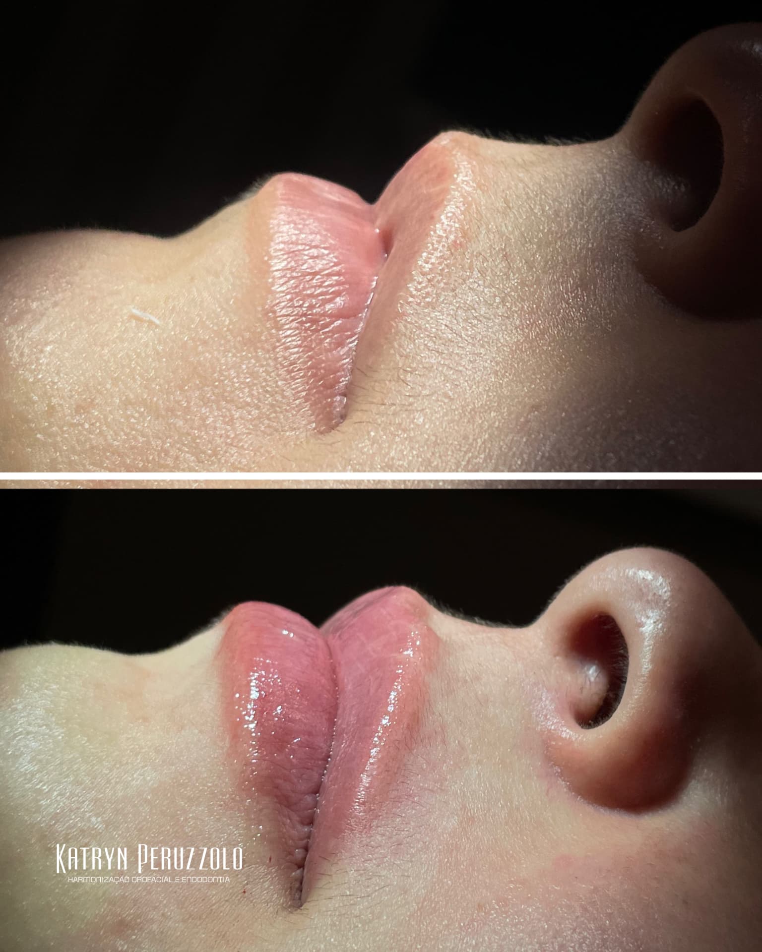 Antes e depois – Preenchimento labial