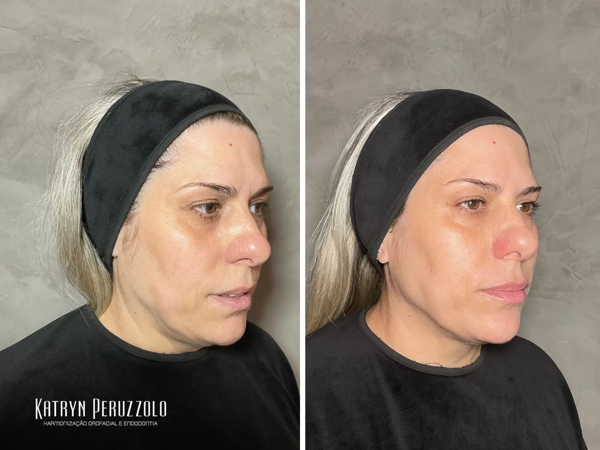 Antes e depois – Harmonização facial – full face