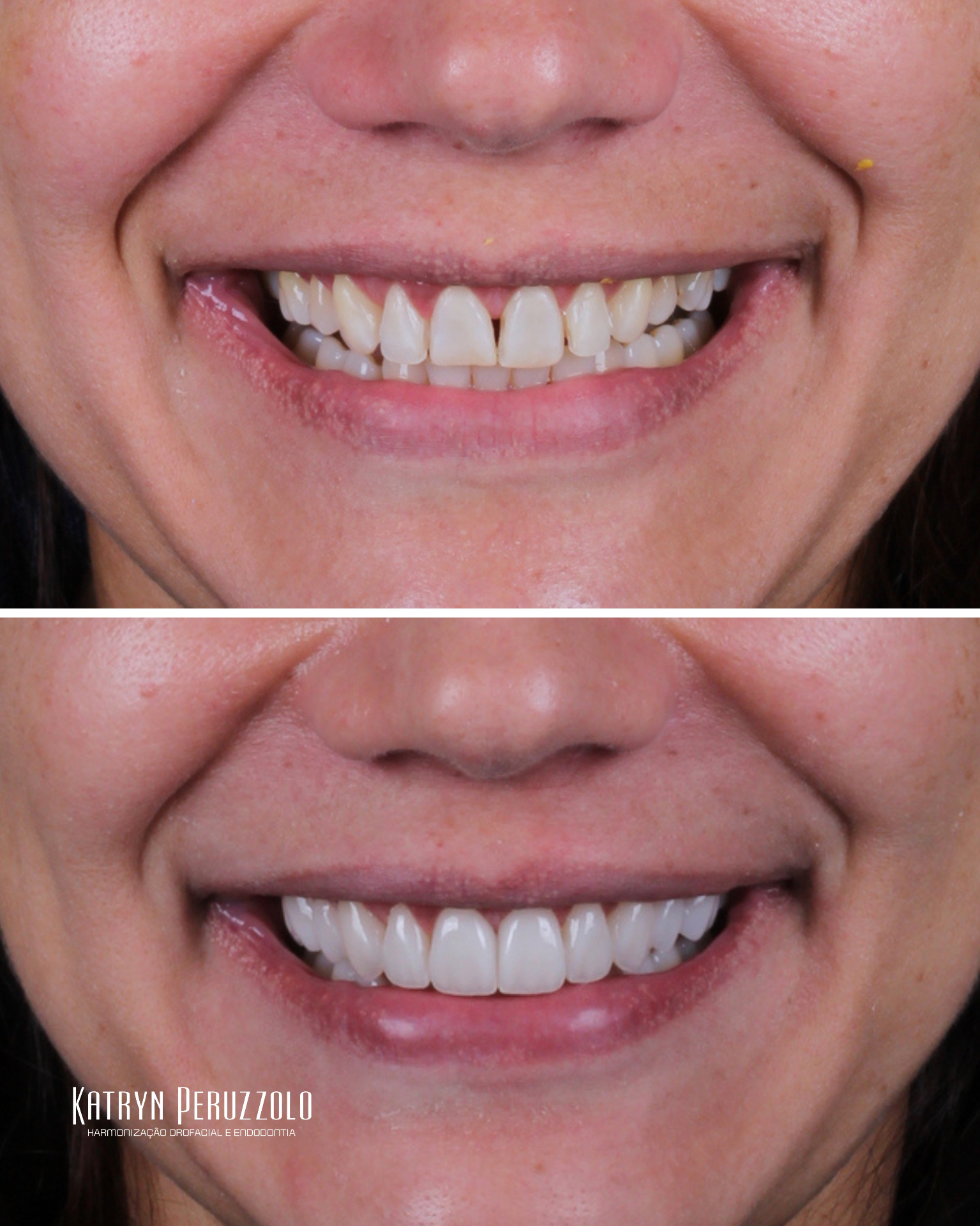 Antes e depois – Lentes de contato dental