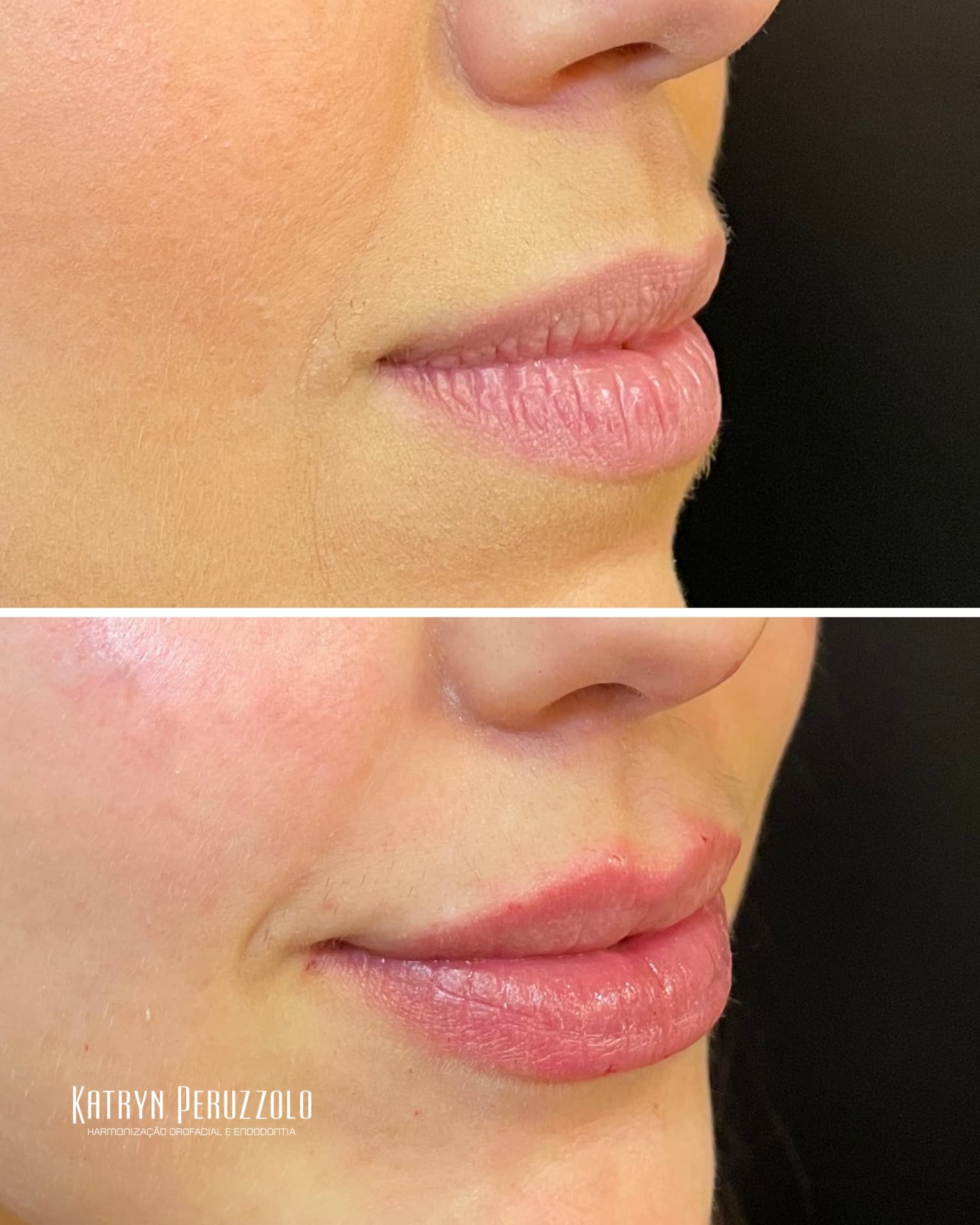 Antes e depois – Preenchimento labial