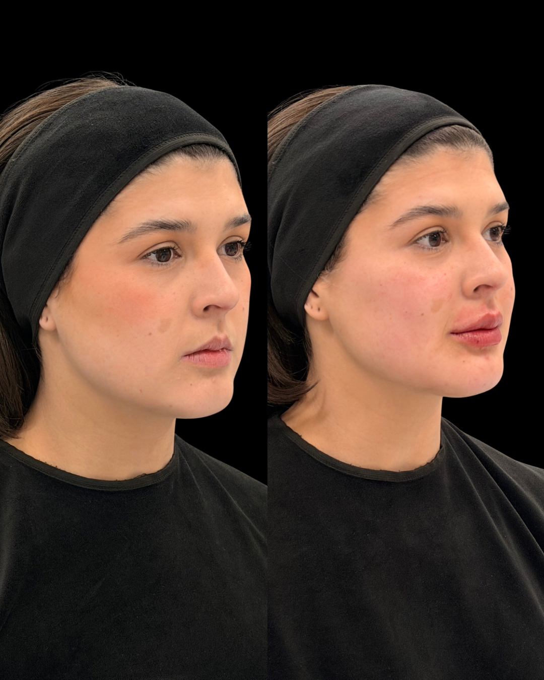 Antes e depois – Harmonização facial – full face