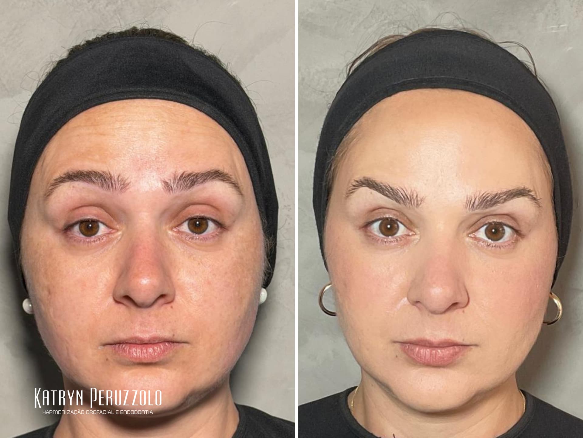 Antes e depois – Ultraformer MPT