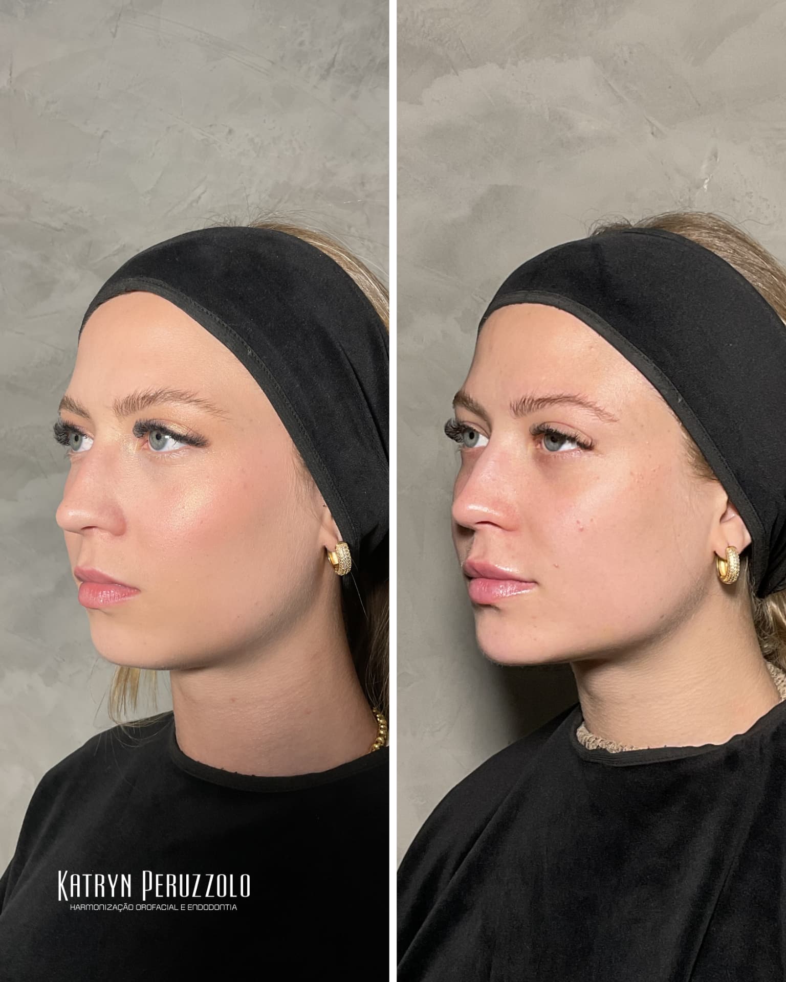 Antes e depois – Preenchimento de mento