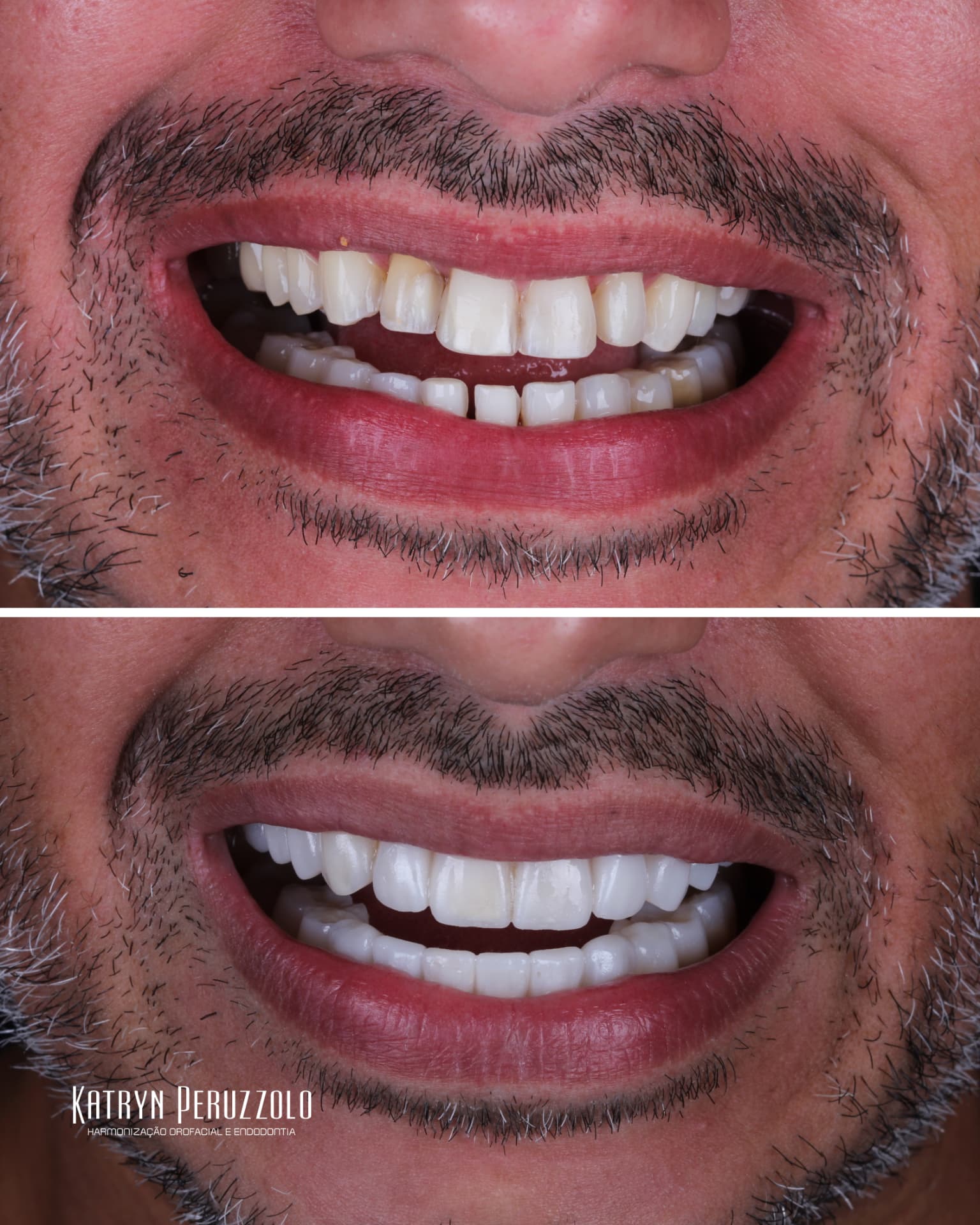 Antes e depois – Lentes de contato dental