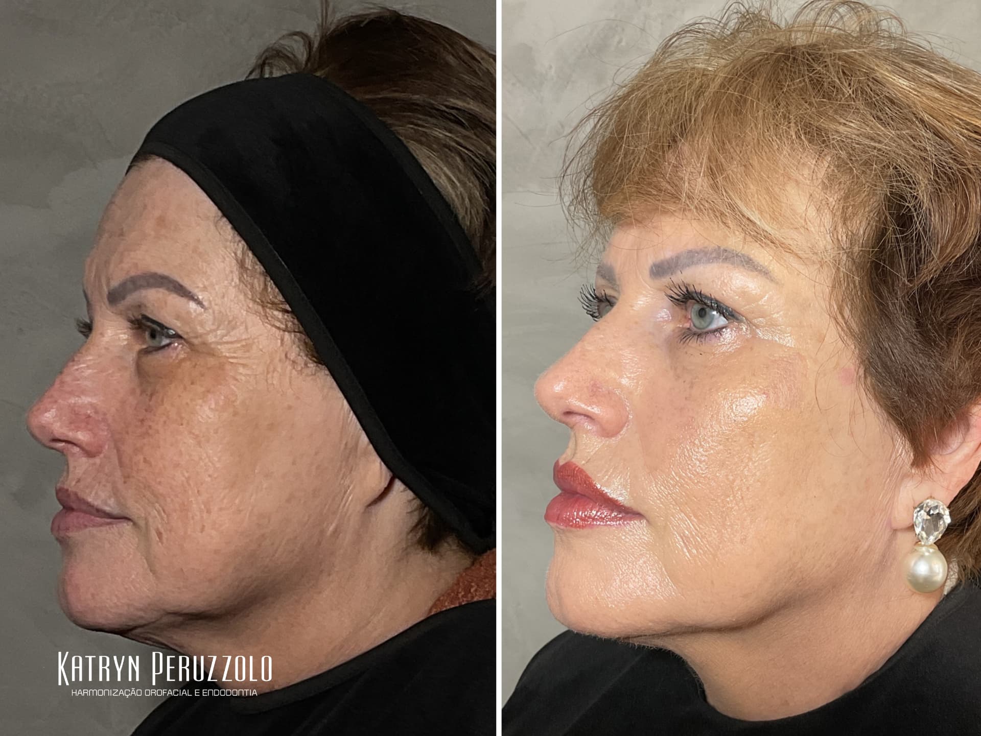 Antes e depois – Ultraformer MPT