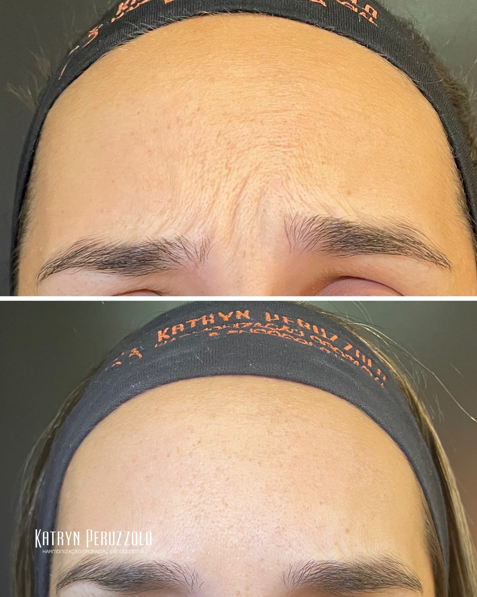 Antes e depois – Toxina botulínica – testa e glabela