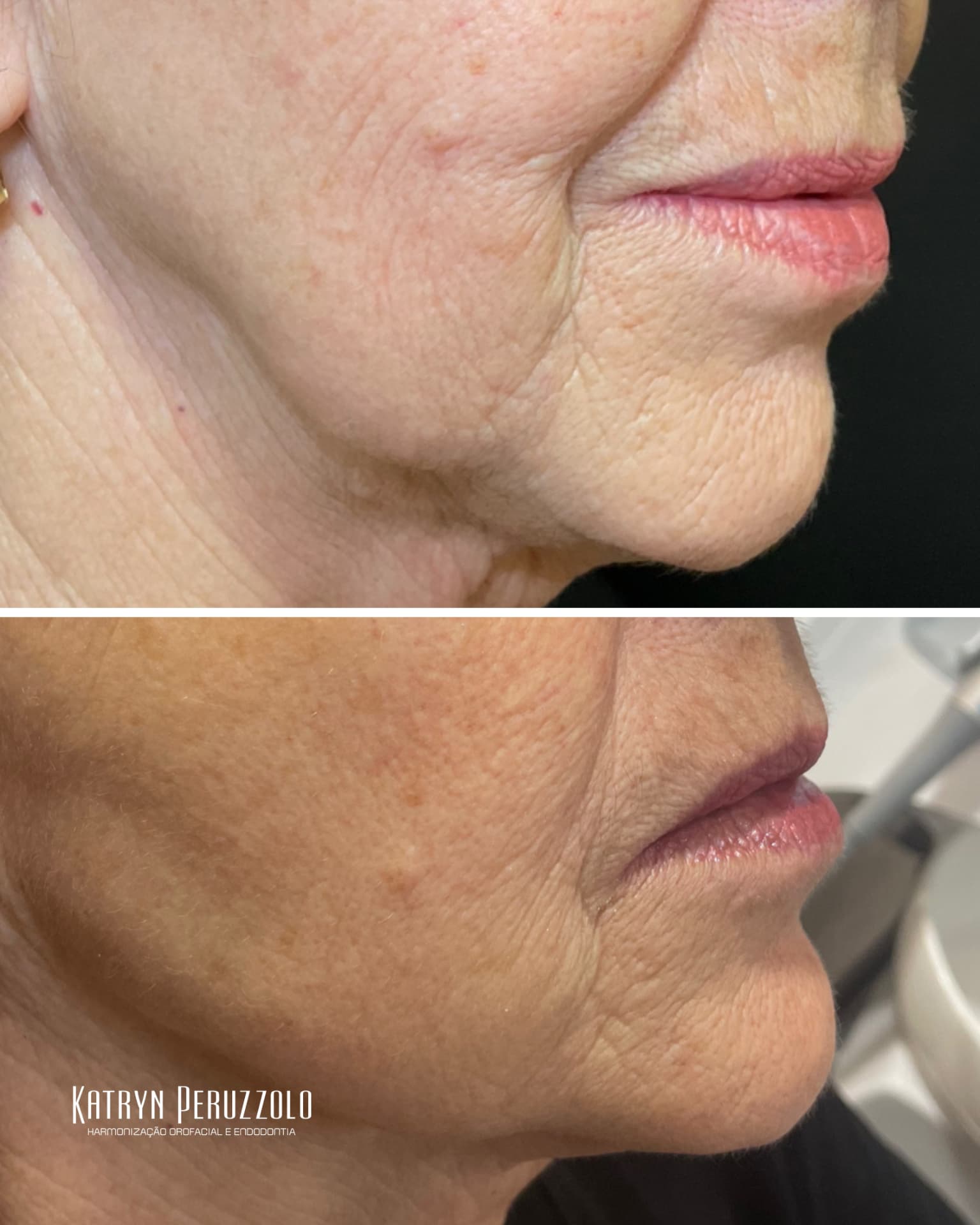 Antes e depois – Ultraformer MPT