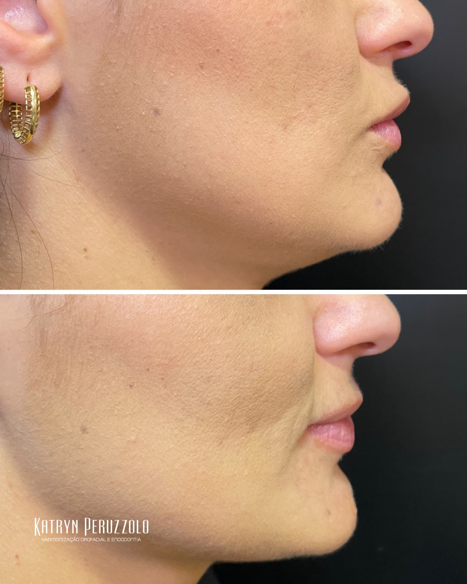 Antes e depois – Ultraformer MPT