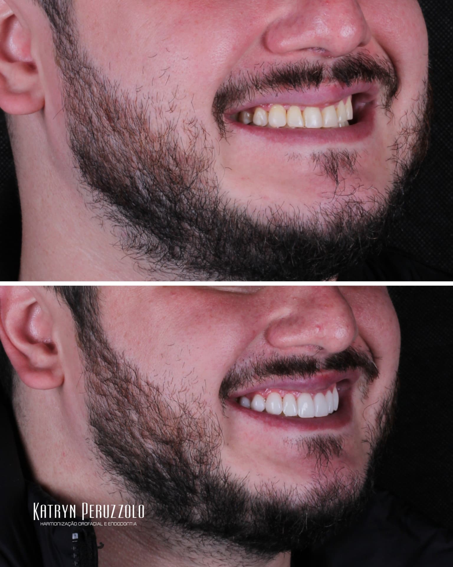 Antes e depois – Lentes de contato dental