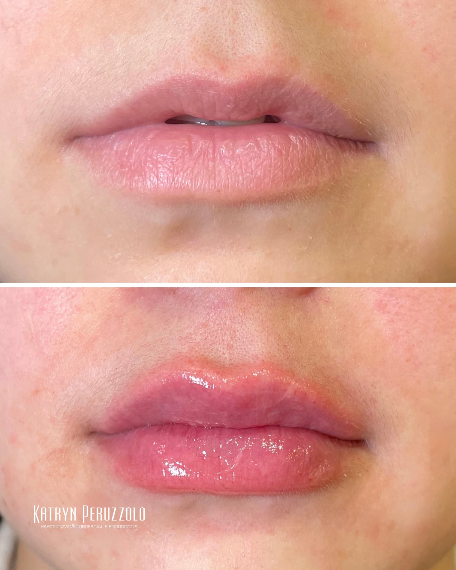 Antes e depois – Preenchimento labial