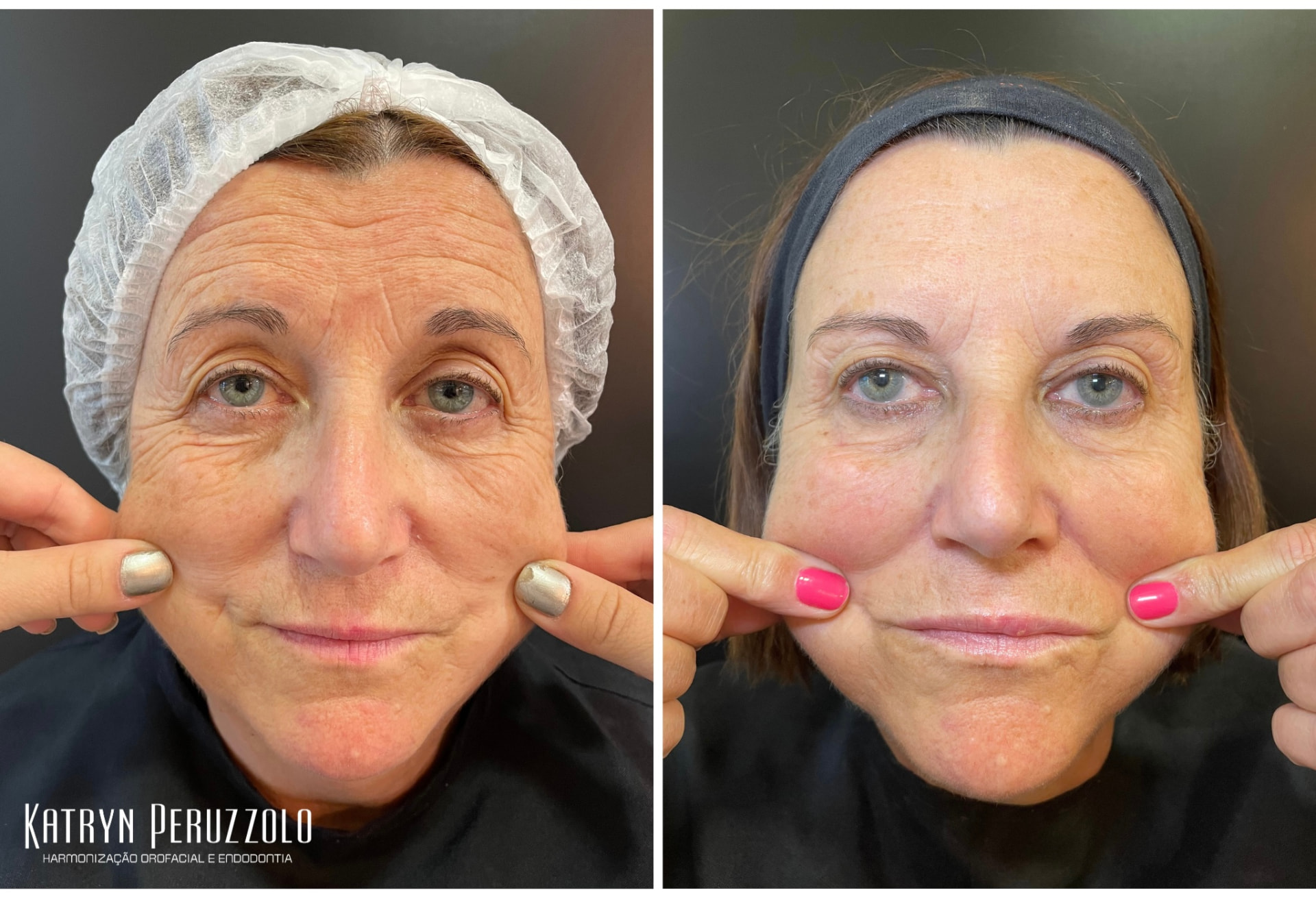 Antes e depois – Bioestimulador de colágeno