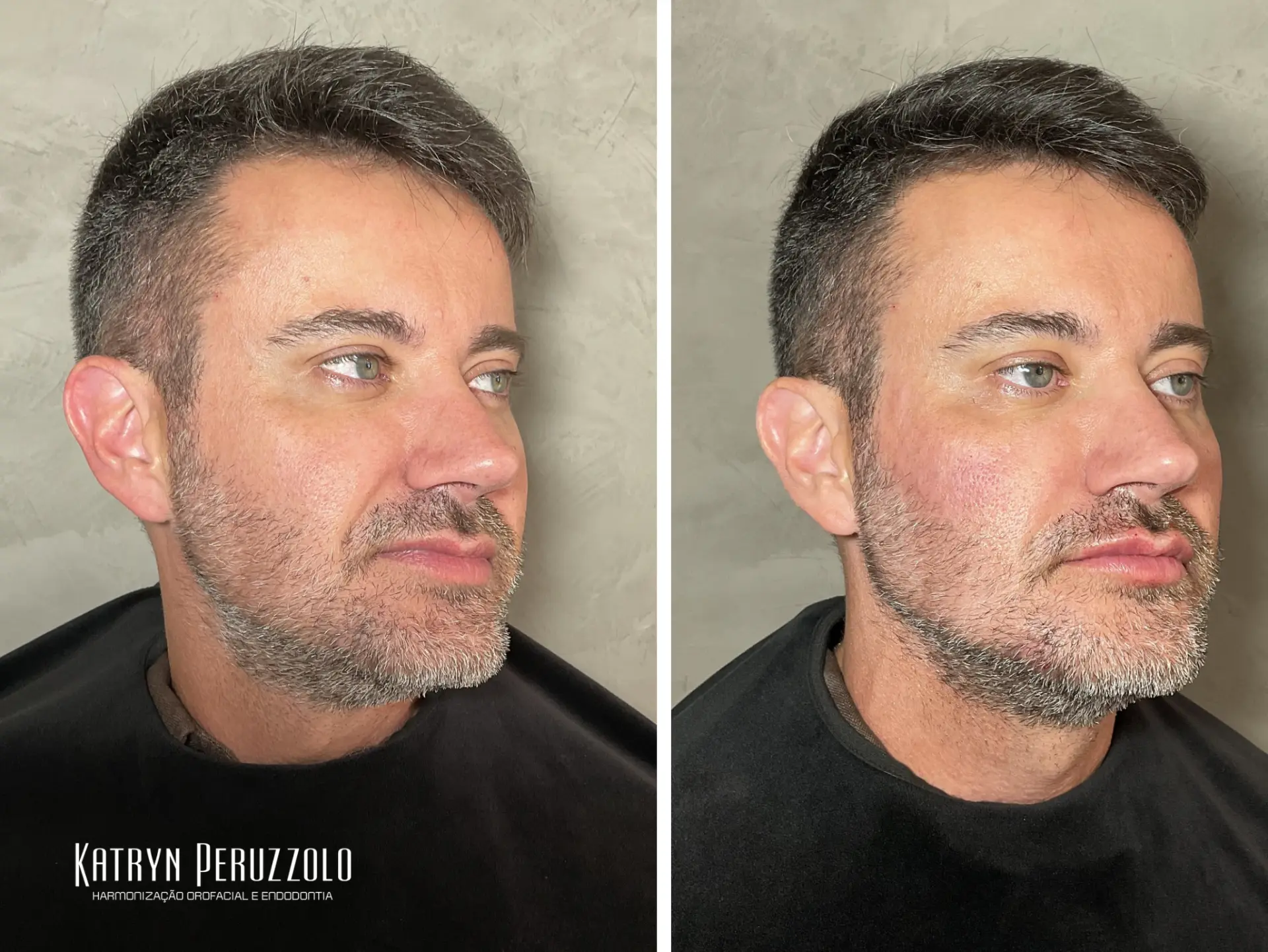 Antes e depois – Harmonização facial – full face