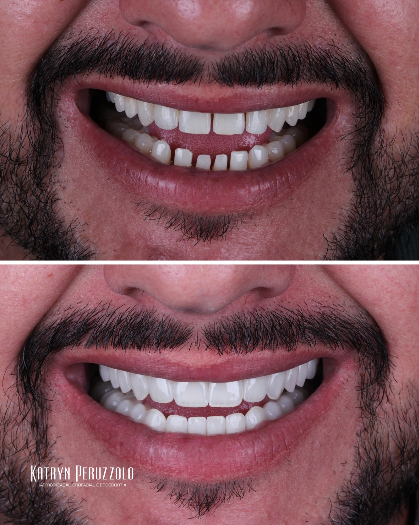 Antes e depois – Lentes de contato dental