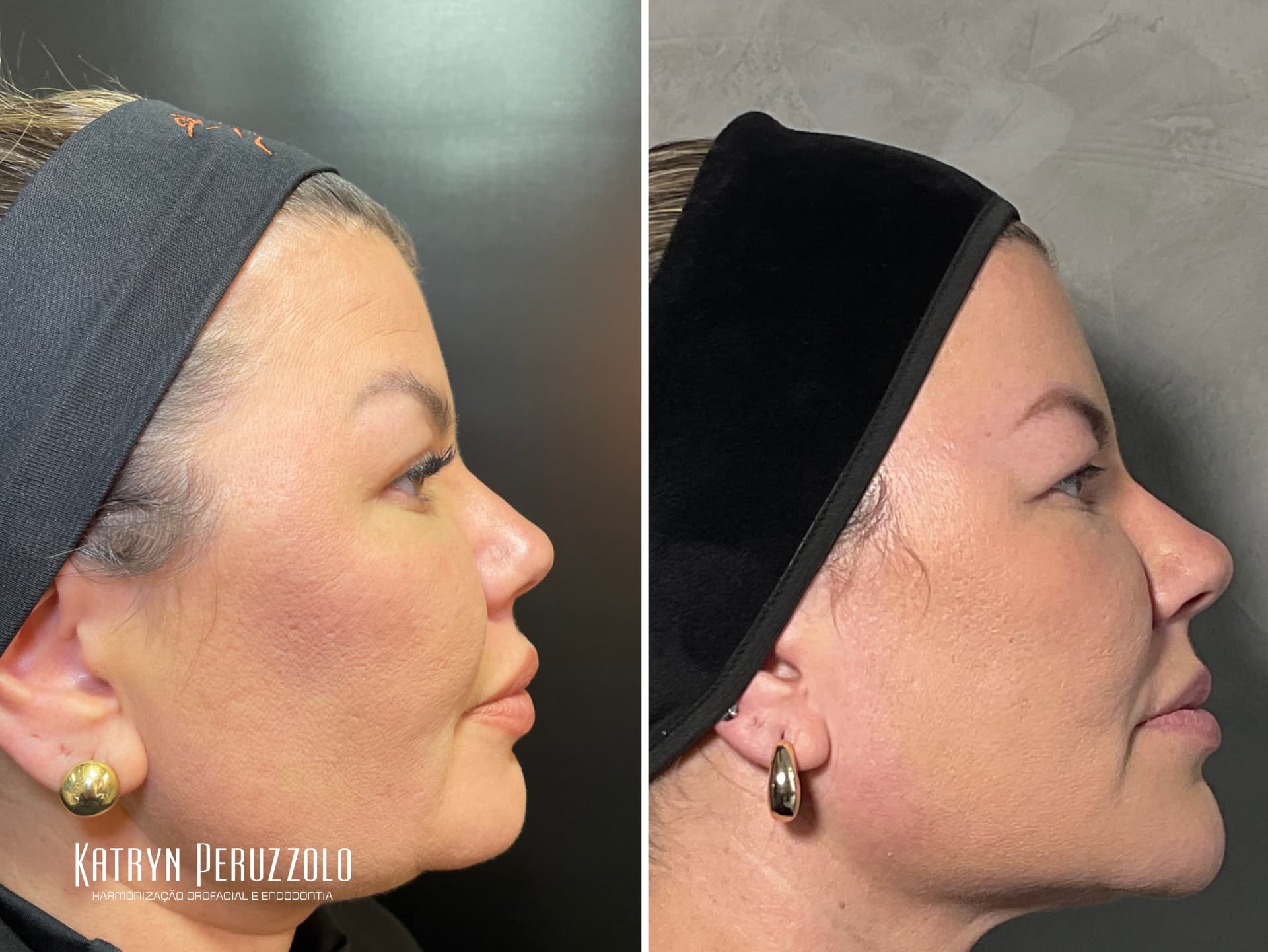 Antes e depois – Harmonização facial – full face