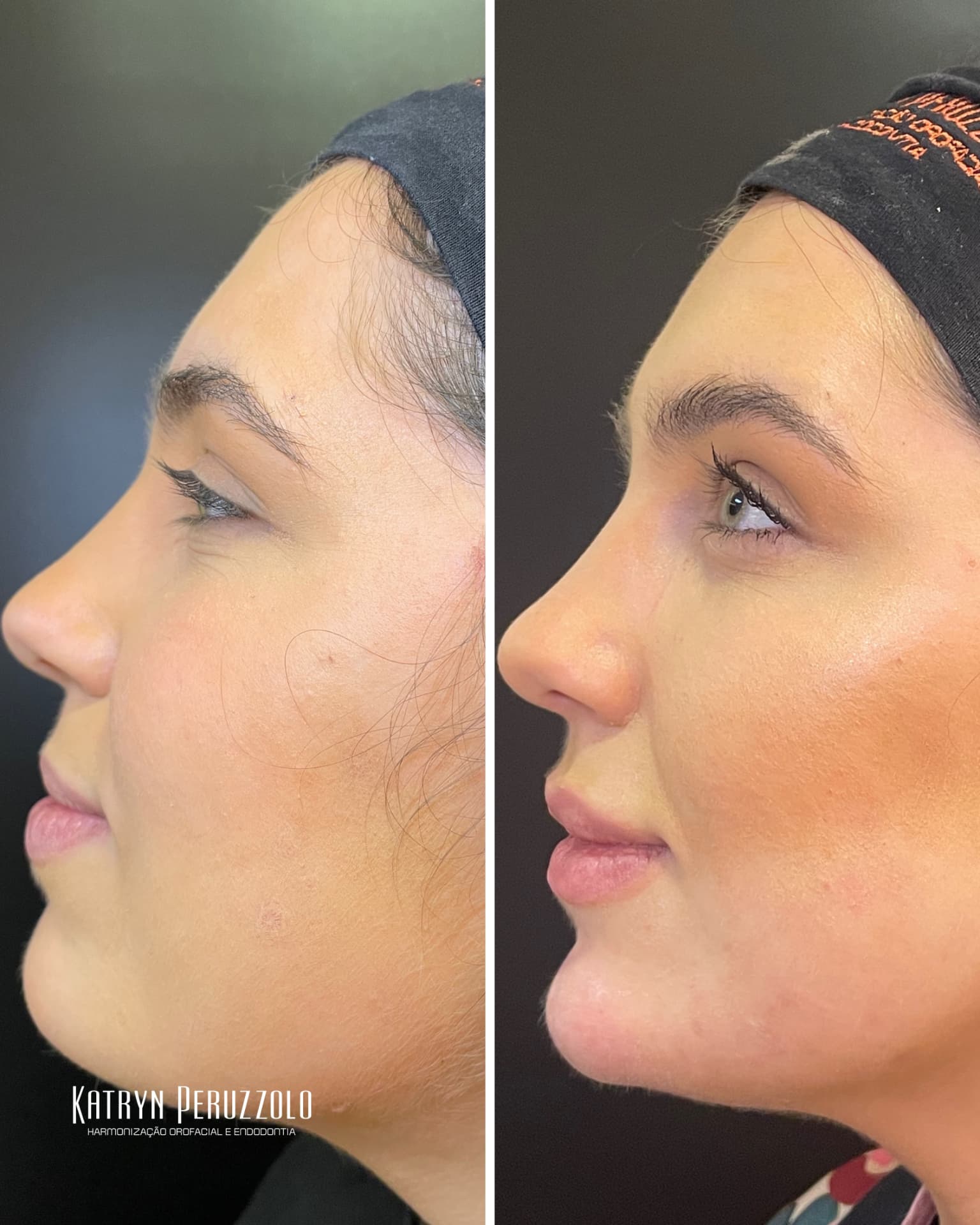 Antes e depois – Harmonização facial completa