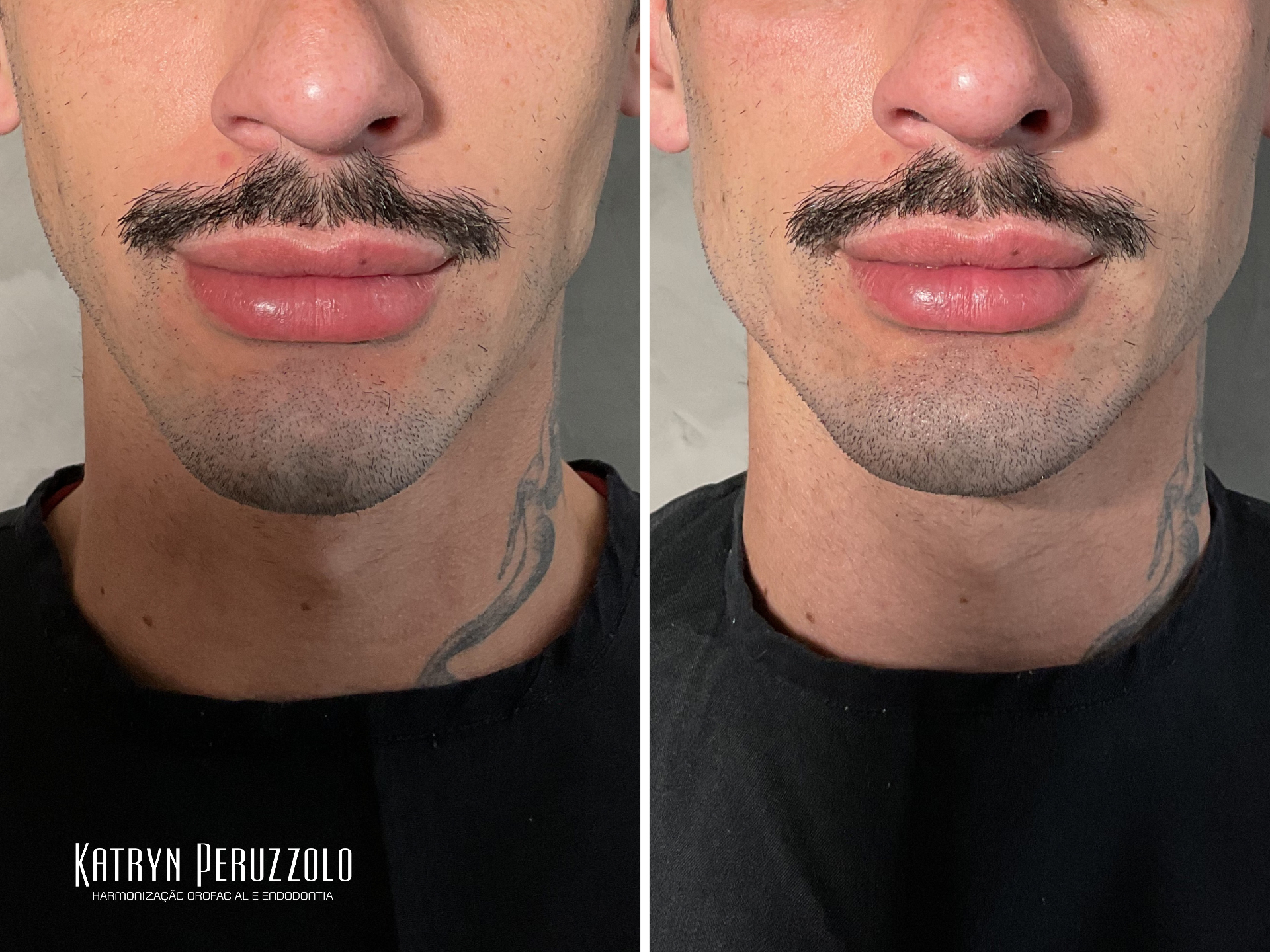 Antes e depois – Harmonização de mento, mandíbula e labial