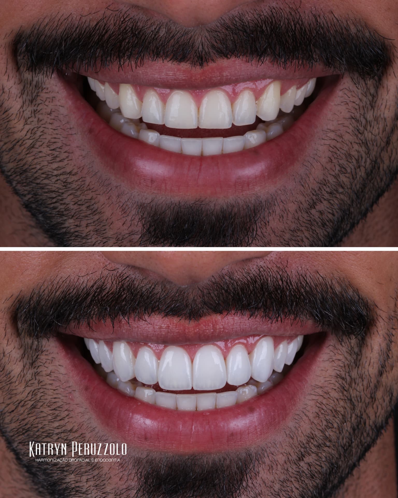 Antes e depois – Lentes de contato dental