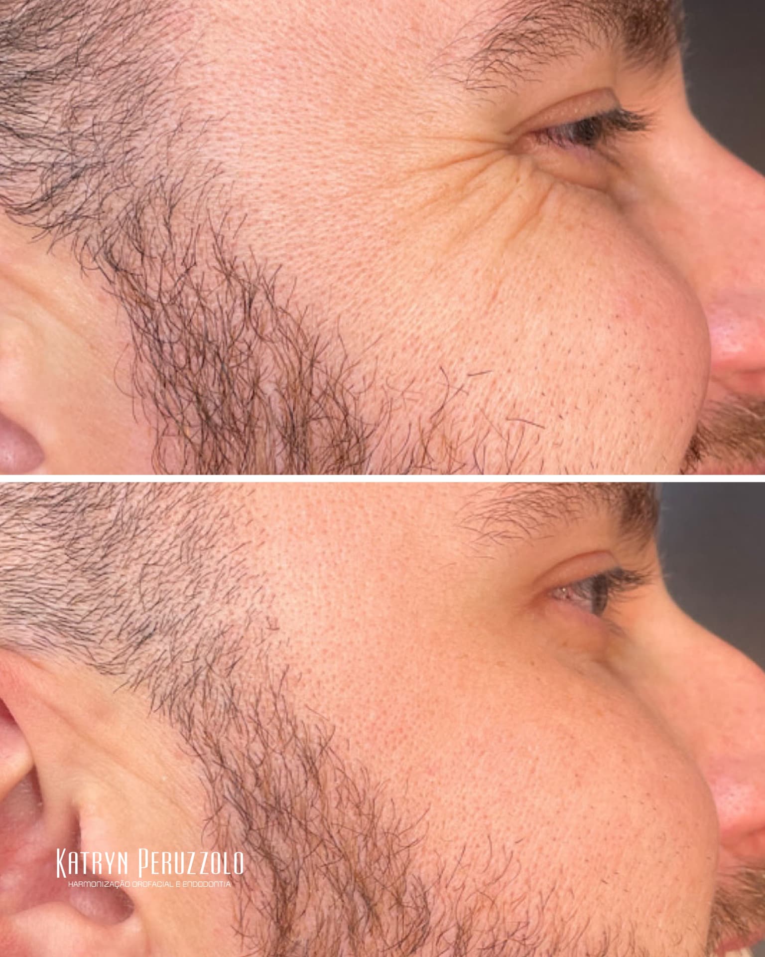 Antes e depois – Toxina botulínica – pés de galinha