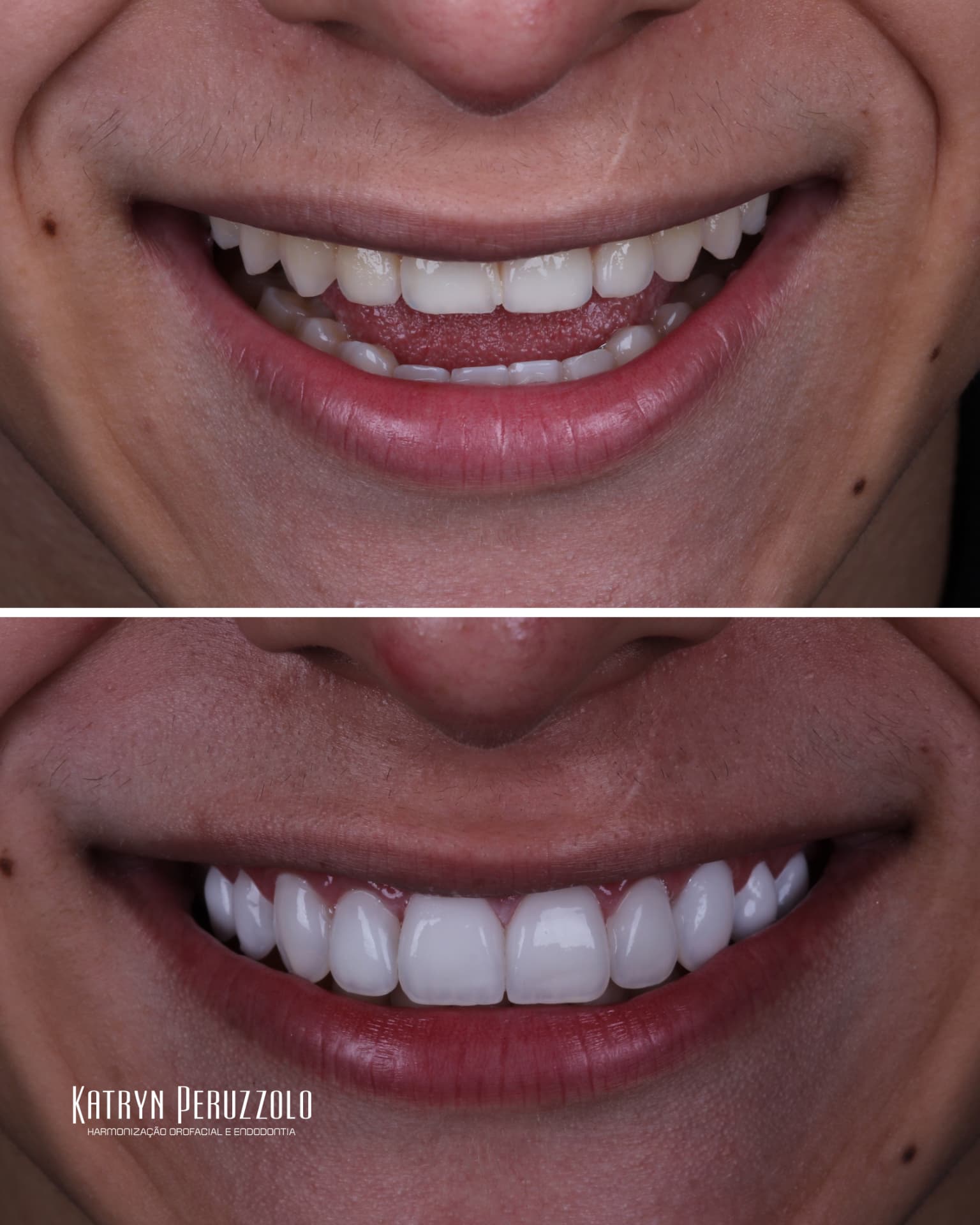 Antes e depois – Lentes de contato dental