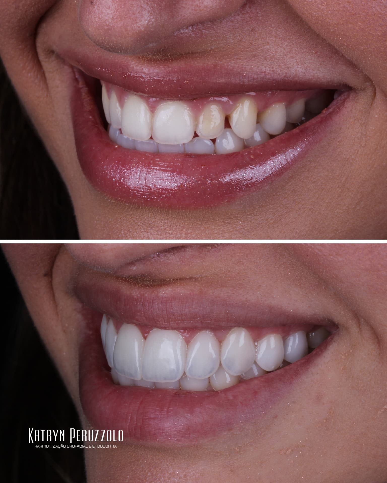 Antes e depois – Lentes de contato dental